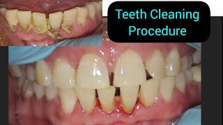 Teeth Cleaning done under Microscope  Calculus Plaque Tartar Removal  Scaling of Teeth [upl. by Rowe]