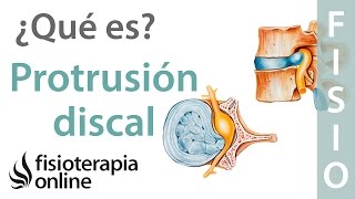 Protrusión discal subligamentosa  ¿Qué es [upl. by Shelly297]