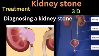 kidney stone treatment  symptoms  removal of kidney stone  Surgery  fatima chem [upl. by Marys]