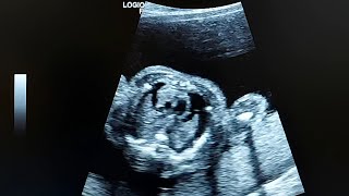 obstetric ultrasound shows isolated bilateral fetal pleural effusions FPE [upl. by Tamsky]