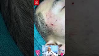 How to Extract Pimples Safely  Tips from Leading Dermatologists Part 11Pimples Blackheads [upl. by Beatrix]