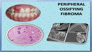 Peripheral Ossifying Fibroma [upl. by Letnuhs]