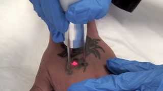 QSwitched NdYAG Tattoo Removal Laser  The Astanza Duality [upl. by Marzi]