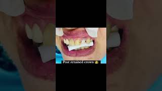 dentistry endodontist endodoncia conservative dentist post fixedcrownrestoration [upl. by Ellerey]