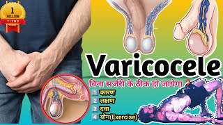 Varicocele।CauseSymptoms Diagnosis And Treatment Of Varicocele।Sugery For Varicocele । In Hindi [upl. by Enrique258]