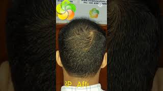 PRP Hair Loss Treatment Before and After  PRP Results [upl. by Neddra498]