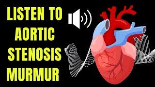 Doctor explains AORTIC STENOSIS including real heart SOUNDS of the murmur [upl. by Abie]