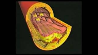 Alleanza dr Rath per la Salute Aterosclerosi e le origini della malattia cardiovascolare [upl. by Fronniah147]