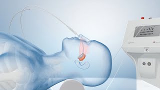 Cancer Treatment with Brachytherapy Medical Animation [upl. by Aros]