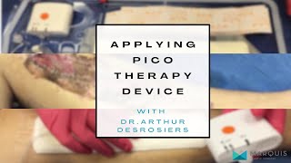 DrArthurMiami applying the PICO negative pressure wound therapy device [upl. by Ursi]