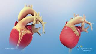 Normal Heart Anatomy vs Hypoplastic Left Heart Syndrome HLHS Anatomy [upl. by Adroj]