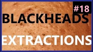 BLACKHEADS EXTRACTIONS on Happy 18 [upl. by Cardew953]