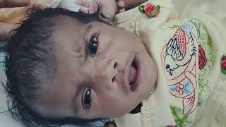 Medical Education Video Neonatology Right Sided LMN Facial Palsy in a baby with Microtia [upl. by Ossy]