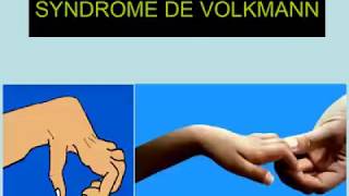 Syndrome de VOLKMANN  Traumatologie [upl. by Lupien]