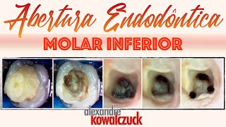 Abertura Endodôntica  Molar Inferior [upl. by Houghton478]