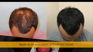 Best laser hair growth device  Laser Treatments for Thinning Hair [upl. by Ilam920]