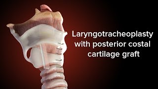 Medical Animation Posterior Cricoid Split  Cincinnati Childrens [upl. by Neelya]