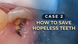 How to save HOPELESS TEETH  Tips amp Tricks  Case 2 [upl. by Ecerehs]