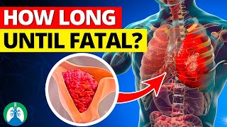 How Long for a Pulmonary Embolism to Become Fatal [upl. by Lorien]