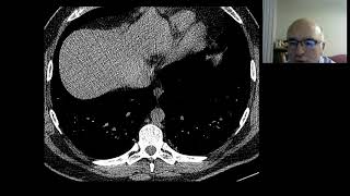 dendriform pulmoner osifikasyon [upl. by Esinehc]