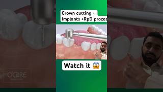 Crown cutting implants RpD 3d process crown implants Rpd 3ddesign dentist [upl. by Meuser676]