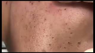 blackhead remover [upl. by Trebornhoj]