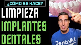 🪥 Cómo LIMPIAR correctamente los IMPLANTES DENTALES [upl. by Sigismundo]