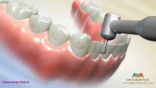 Removing Orthodontic Braces or Debond [upl. by Aliahs]