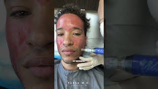 Microneedling with PRP for Acne Scars  Kami Parsa MD skincare acnescars [upl. by Ahsienet197]