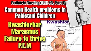 Malnutrition in Pakistani Children Understanding Marasmus Kwashiorkor PEM amp Failure to Thrive [upl. by Edie]