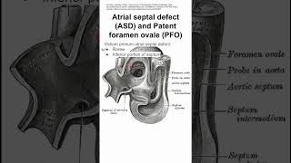 Atrial septal defect ASD and Patent foramen ovale PFO [upl. by Aisitel]