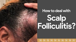 Dealing with Scalp Folliculitis Watch immediately [upl. by Aleuname]