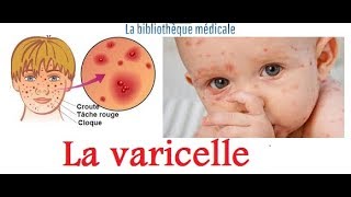 La varicellediagnosticcliniquetraitement et Prévention [upl. by Renruojos]