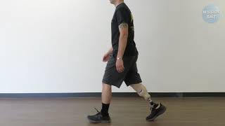 Amputee Trendelenburg Gait  Case Study 27 [upl. by Markland]