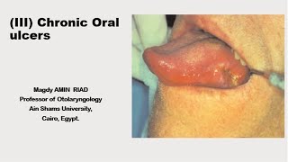 III Chronic Oral Ulcers [upl. by Skardol]