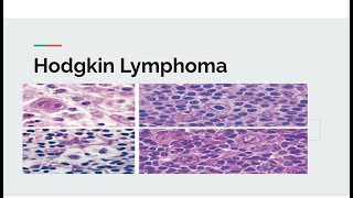 Hodgkin lymphoma [upl. by Glaab]