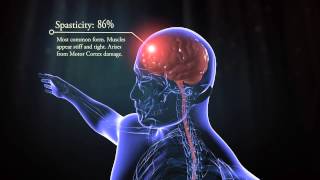 Types of cerebral palsy [upl. by Germano]