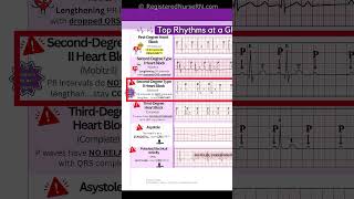 ECG EKG Rhythms to Know Sinus Rhythms Sinus Tachycardia Heart blocks etc [upl. by Felipe]