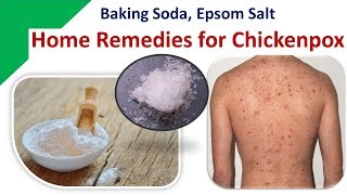 Home Remedies for Chickenpox  Baking Soda Epsom Salt [upl. by Jac612]