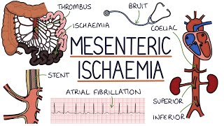 Understanding Mesenteric Ischaemia [upl. by Rasure]