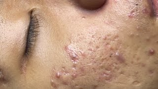 ACNE TREATMENT VU QUYNH MI  Perennial Blackheads On Boy Face 2024FULL [upl. by Arahset]