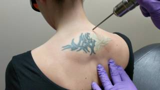 Laser Tattoo Removal  DermMedica [upl. by Leschen612]