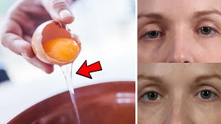 Fix Droopy Eyelids Instantly Without Surgery – Home Remedies for Droopy Eyelid [upl. by Gilcrest156]