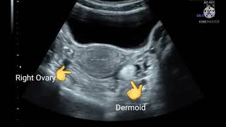 Left ovarian dermoid cyst [upl. by Ekal]