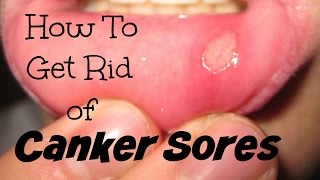 How To Get Rid of Canker Sores [upl. by Drofub77]