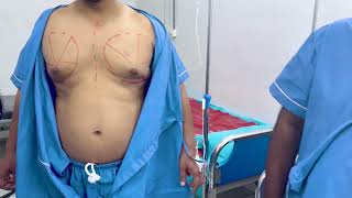 Gynecomastia Surgery Marking in Bangladesh by Dr Sharif [upl. by Daigle]