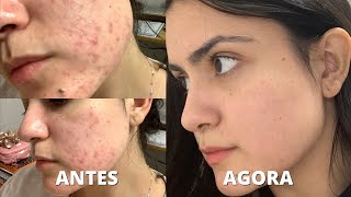 como me livrei das minhas acnes  rotina de skincare PRODUTOS COREANOS 🇰🇷 [upl. by Alius591]