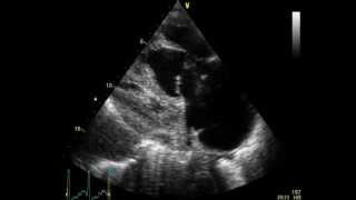 PULMONARY EMBOLISM  EMBOLIE PULMONAIRE  ECHOCARDIOGRAPHY cardiac ultrasound [upl. by Aitercal799]