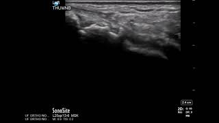 Hand Ultrasound Scaphotrapeziotrapezoid STT Joint Injection [upl. by Uaeb958]