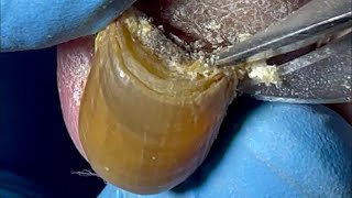 Clean onychomycosis live broadcast in nursing homes [upl. by Cathryn]